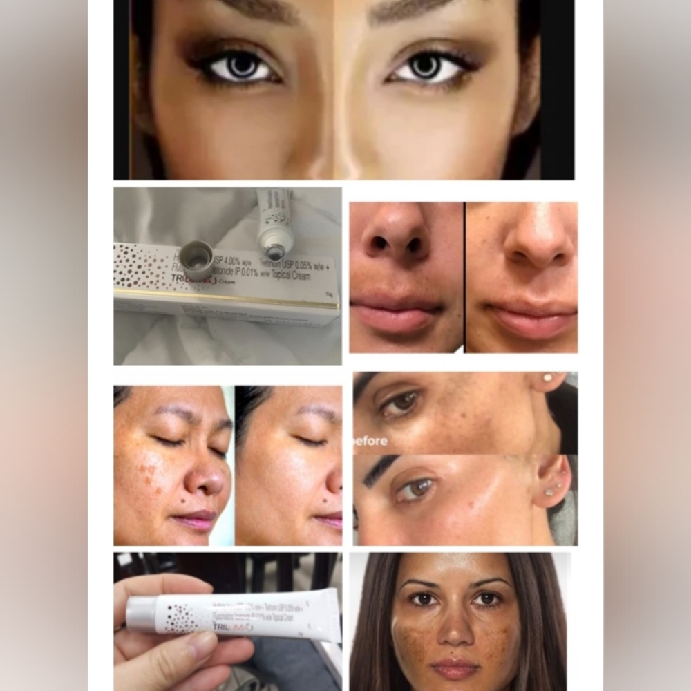 Hyperpigmentation Skincare